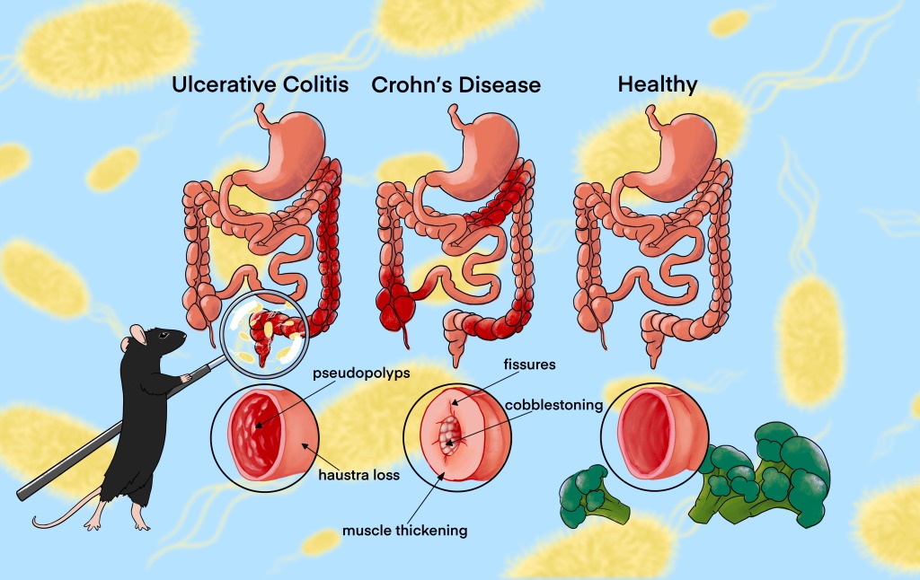 A cartoon of three gastrointestinal tracts showing the locations of inflammation in ulcerative colitis, crohn's disease, or healthy tissue. At the bottom are cross-sections showing thickening of the intestinal wall in patients with Crohn's, and ulcers in patients with colitis.